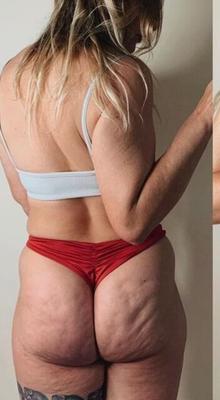 Culote haut de cellulite